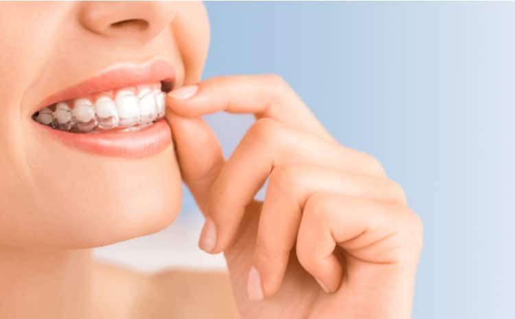 clear aligners australia